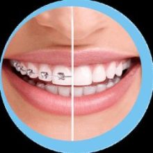 clear aligners vs braces in Karachi