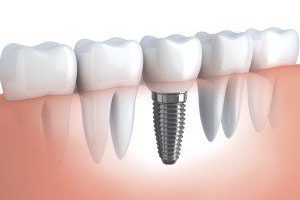 dental implants DHA Karachi